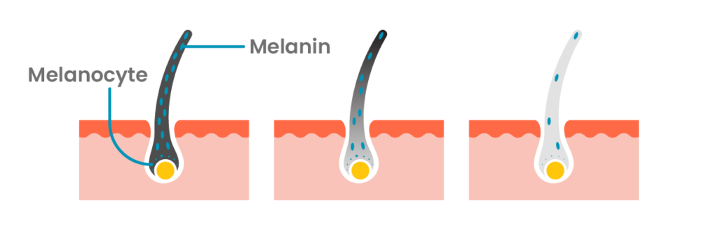 Una ilustración que muestra el envejecimiento del cabello, desde una pigmentación completa hasta volverse completamente gris, debido a la reducción de la producción de melanina por parte de los melanocitos.